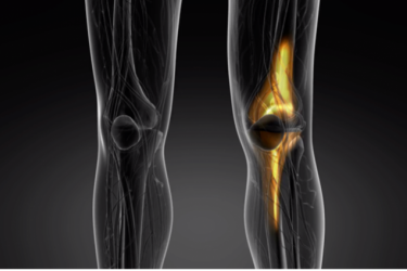 先进的关节置换手术快火挑战-预告片